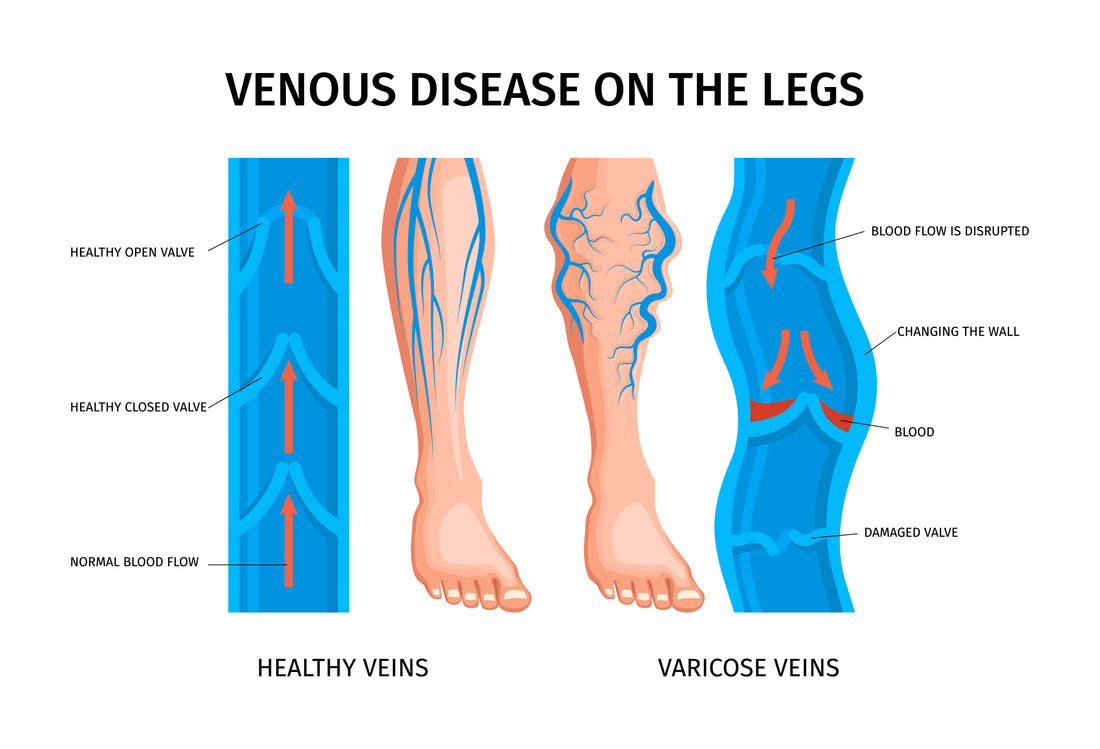 Say Goodbye to Varicose Veins with Vein Healing Varicose Veins Treatment Spray