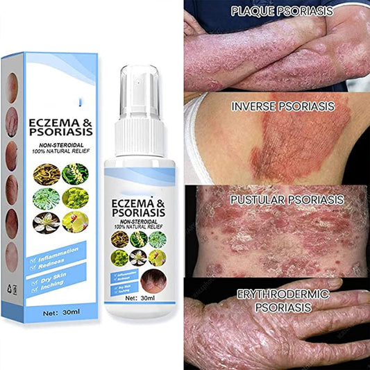 Herbal Psoriasis Relief Spray -Eczema Relief Spray, Stops Burning and Itching Pack of 1 of 30ML