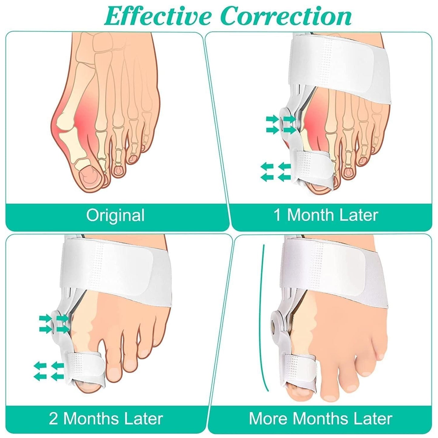 Silicone Toe Separator For Adults Bunion Corrector Splint Kit For Toe - Deal IND.