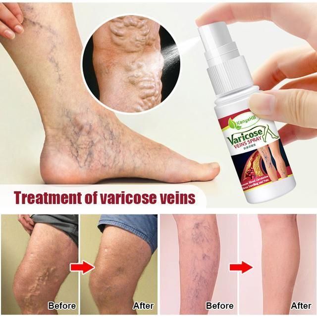 Vein Healing Varicose Veins Treatment Spray - Deal IND.