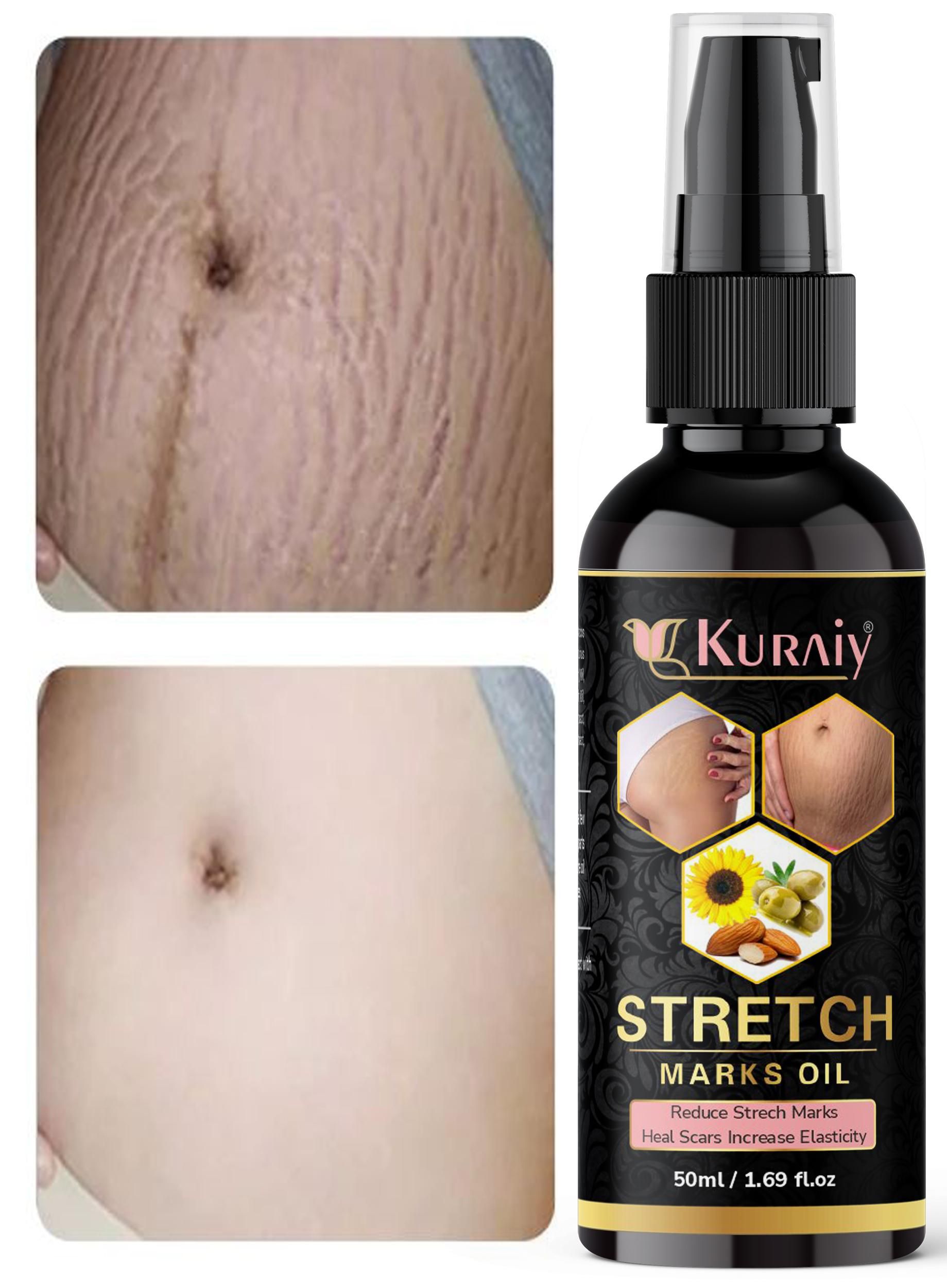 Kuraiy present Repair Stretch Marks Removal - Natural Heal Pregnancy Breast, Hip, Legs, Mark oil 500 ml pack of 1 - Deal IND.