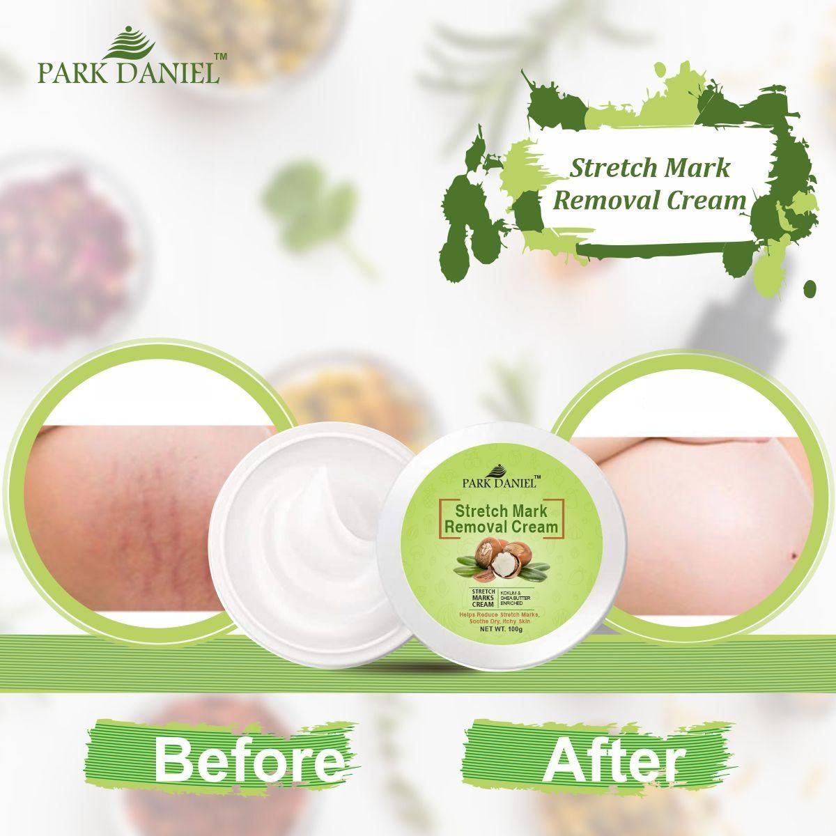 Park Daniel Stretch Marks Removal During Pregancy | Weight Loss Skin Toining (100 grams) - Deal IND.