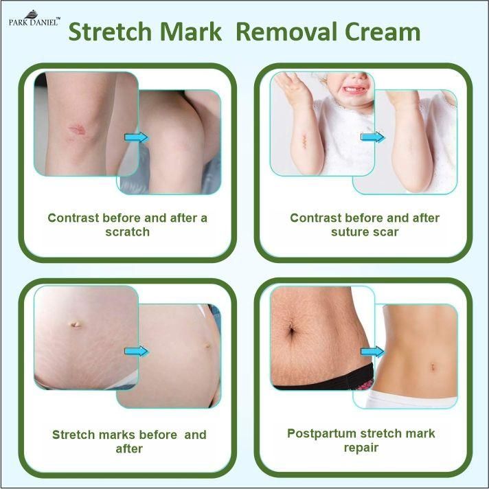 Park Daniel Stretch Marks Removal During Pregancy | Weight Loss Skin Toining (100 grams) - Deal IND.