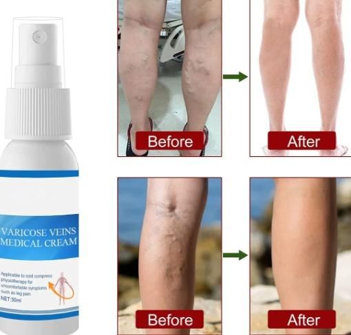 Varicose Vein Cream Spray Varicose Vein Legs and Varicose Vein Swelling L3g1 (Pack of 2) - Deal IND.